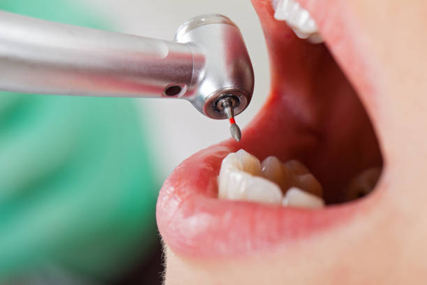 Best Emergency Dentist for Lost Fillings or Crowns in Sumter, SC